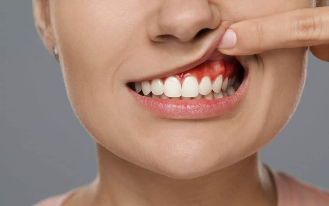 Evitar la periodontitis en tus encias