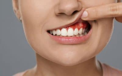 ¿Cómo evitar la periodontitis?