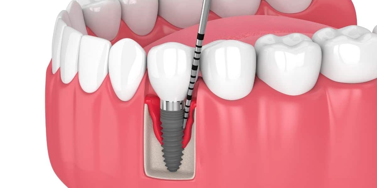 osteointegracion implante dental