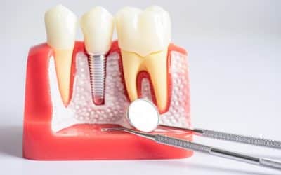 ¿Qué es la osteointegración dental?
