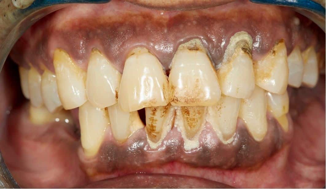 dentadura con periodontitis