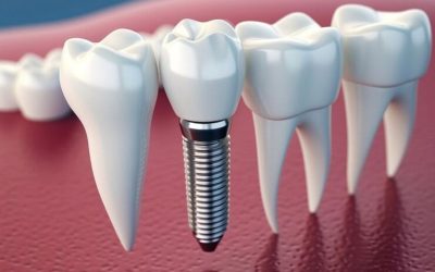¿Qué es la osteointegración?
