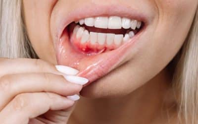 ¿Por qué me sangran las encías? Causas y soluciones