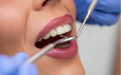 ¿Qué es la abrasión dental?