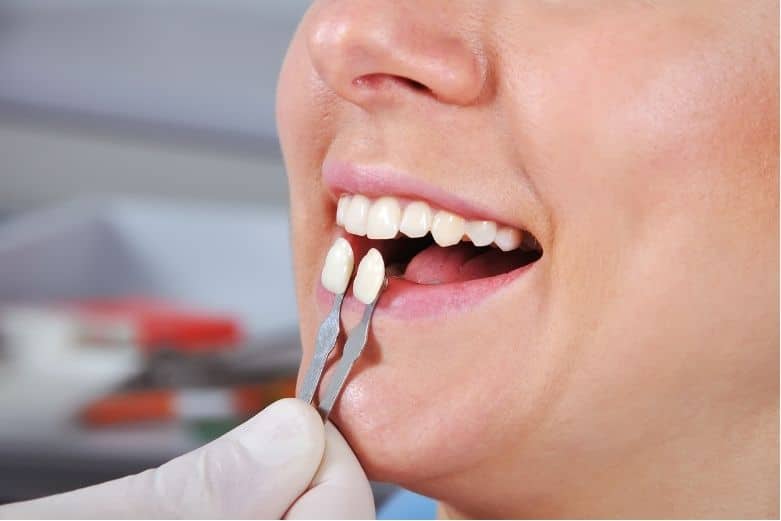 Cuánto duran las carillas dentales